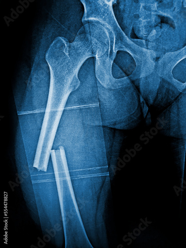 Film X-ray femur show complete fracture shaft of femur and displace