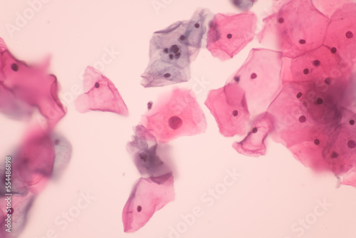 iew in microscopic of Abnormal human cervix cells.Squamous epithelium cells.Superficial and intermediate epithelial cells.Cytology and pathology laboratory department.Magnification 400 X photo