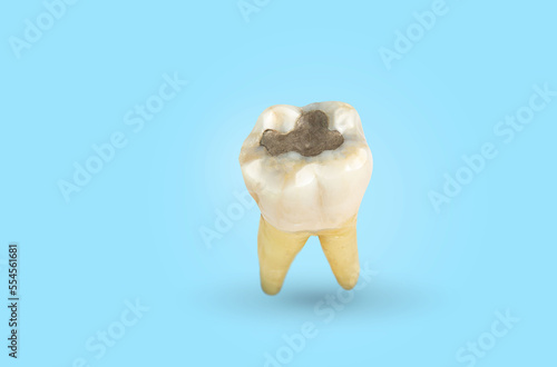  Macro of a tooth containing amalgam. Dental caries and Dental cavity with calculus. light blue background . Front side view . Tooth decay and tooth decay begins to decay.