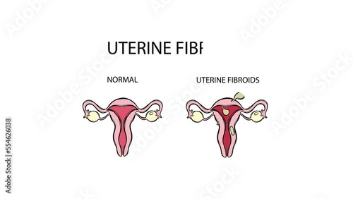 UTERINE FIBROIDS VS NORMAL VIDEO Leiomyoma Benign Tumor Of The Smooth Muscles Of The Uterus Painful Or Severe Menstruation Medical Animation Education Banner photo