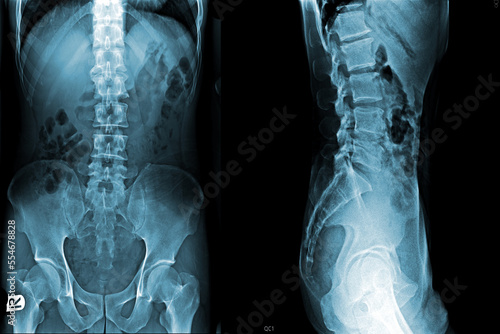Film x-ray of medical use