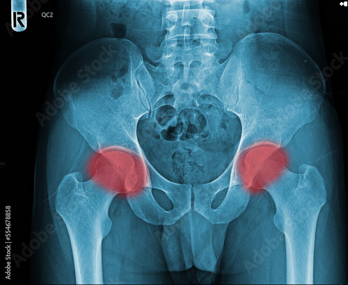 Film x-ray normal pelvis human anatomy