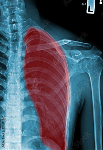 X-ray chest show Coronavirus disease COVID-19 virus infection in human lungs