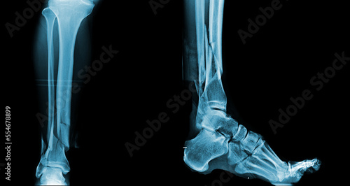 x-ray image of fracture leg bone .