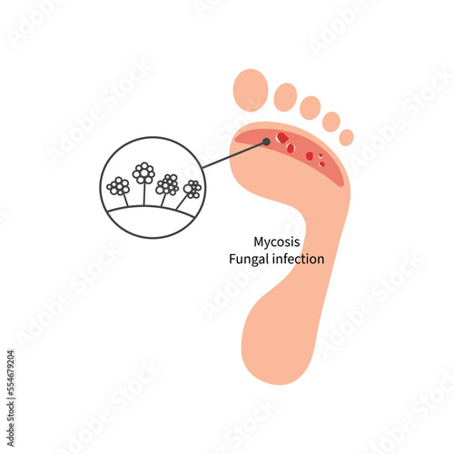 Foot with fungal skin disease