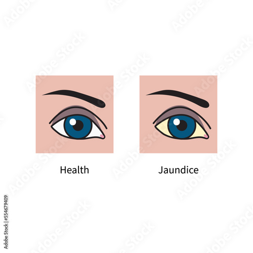 Yellow sclera of eyeball in hepatitis