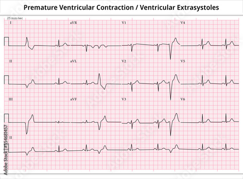 ECG PVC (Premature Ventricular Contractions) - ECG VES (Ventricular Extrasystoles) - 12 Leads ECG Paper