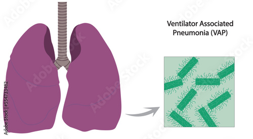 Ventilator associated pneumonia (VAP) illustration. Infection in the airway associated with intuístes patient in mechanical ventilation.
