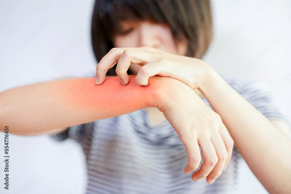Itching (Pruritus) is a common skin condition that often leads to scratching. Itching (Pruritus) is a common skin condition that often leads to scratching.