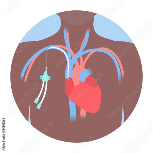 Tunneled central venous catheter placed in the subclavian vein. Patient with CVC long term access device for chemotherapy infusions and blood sampling. Central line tube close up. Vector illustration.