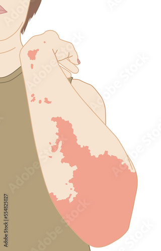 Allergic red rash or urticaria on woman's arm and elbow, flat illustration on white background