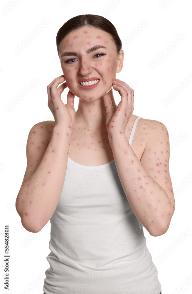 Woman with rash suffering from monkeypox virus on white background Woman with rash suffering from monkeypox virus on white background