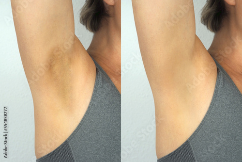 Dark armpit skin caused by allergies and a healthy armpit. Image before and after treatment