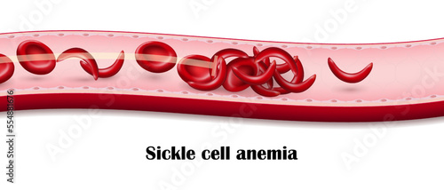 Sickle cell disease. Blood flow of sickle cell anemia.
