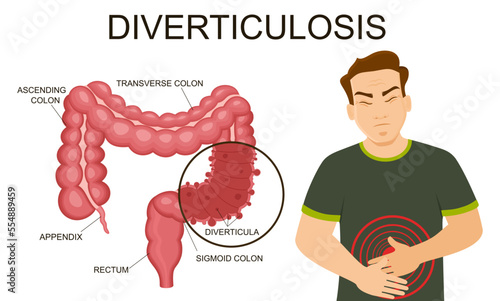 Diverticulosis vector illustration. Medical structure and location. Diverticula infected or inflamed. Intestines. Bowel colon cancer, crohn's disease polyp hernia rectum. Colorectal problems.
