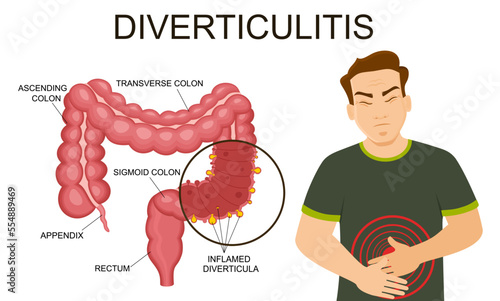 Diverticulitis and diverticulosis vector illustration. Medical structure and location. Diverticula infected or inflamed. Intestines. Bowel colon cancer, crohn's disease polyp hernia rectum 