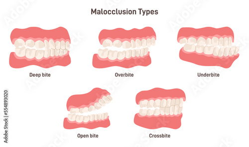 Malocclusion types set. Human crooked teeth. Misalignment or incorrect