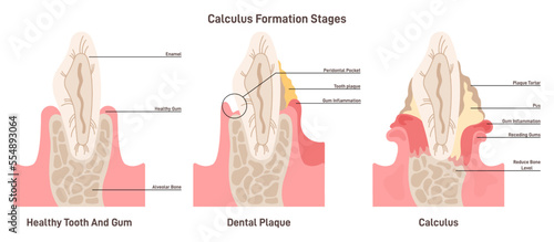Dental tartar or calculus formation stages. Dental plaque disease