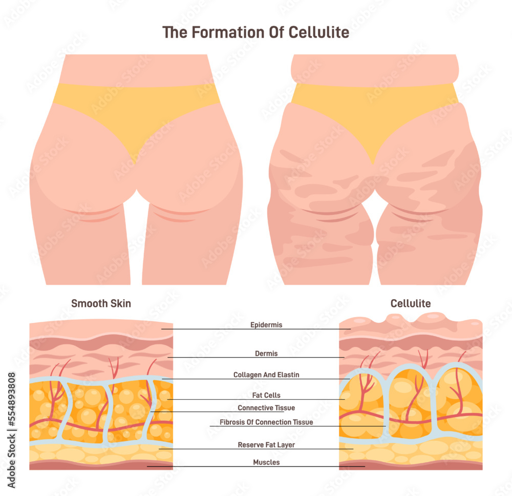 Cellulite and healthy skin structure. Herniation of subcutaneous fat within - obrazy, fototapety, plakaty 