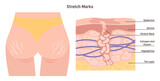 Anatomy of skin with stretch marks. Skin stretches or shrinks quickly.