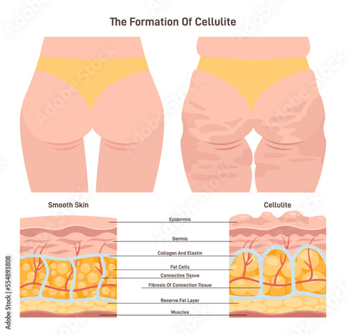 Cellulite and healthy skin structure. Herniation of subcutaneous fat within