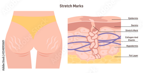Anatomy of skin with stretch marks. Skin stretches or shrinks quickly.