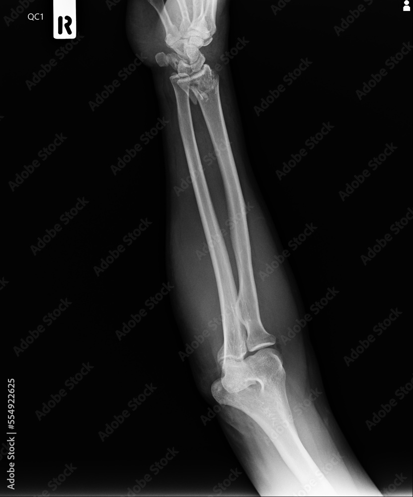 Film x-ray Complete fracture Forearm Film x-ray Complete fracture Forearm