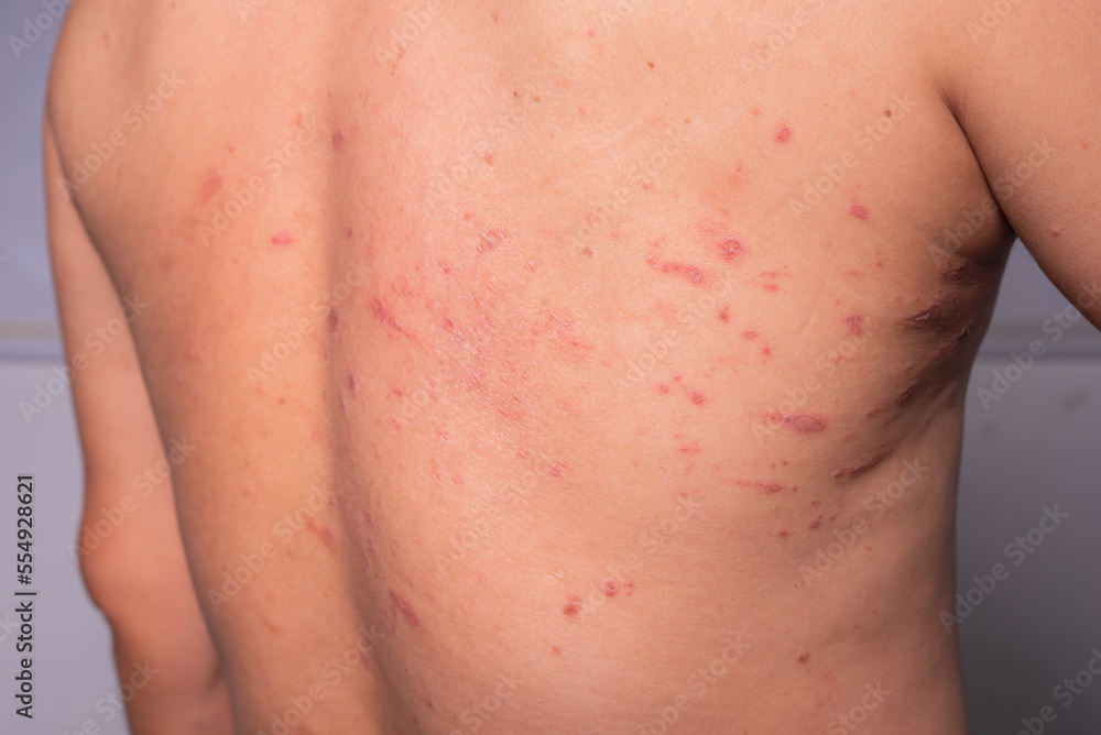 man's back was covered with many red wounds. insect allergy full back rash skin disease man's back was covered with many red wounds. insect allergy full back rash skin disease
