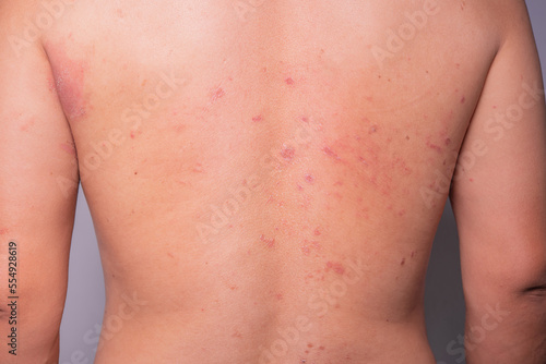 man's back was covered with many red wounds. insect allergy full back rash skin disease