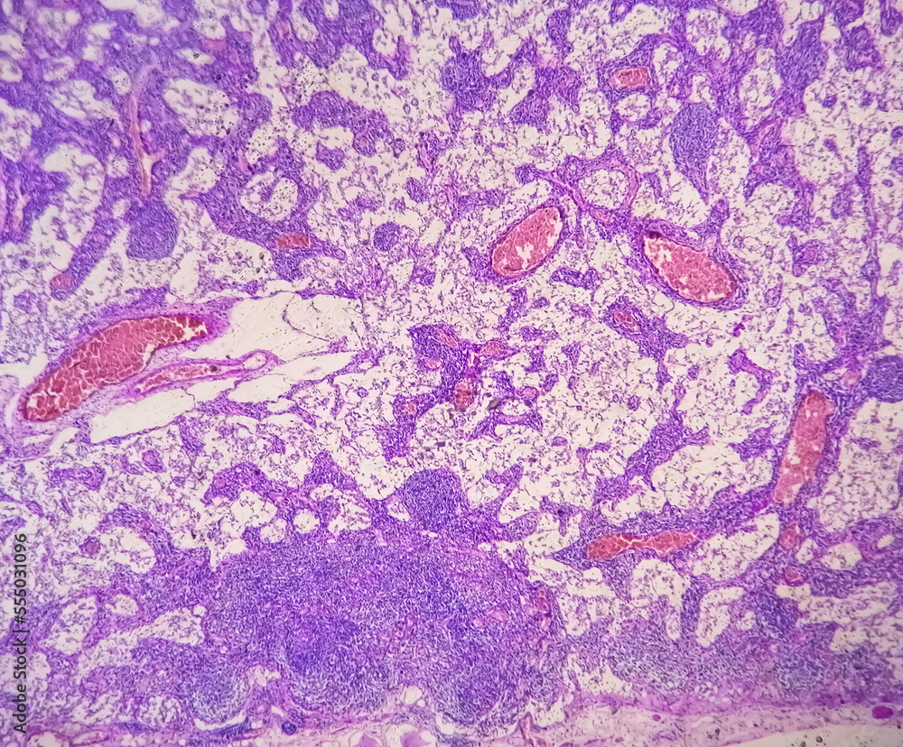 Photomicrograph of Stomach Adenocarcinoma. Gastric Adenocarcinoma ...