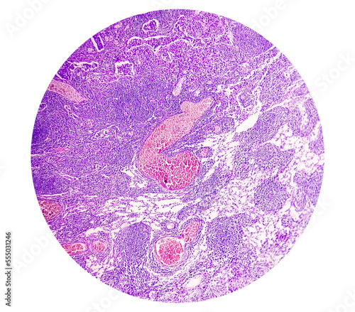 Photomicrograph of Stomach Adenocarcinoma. Gastric Adenocarcinoma.