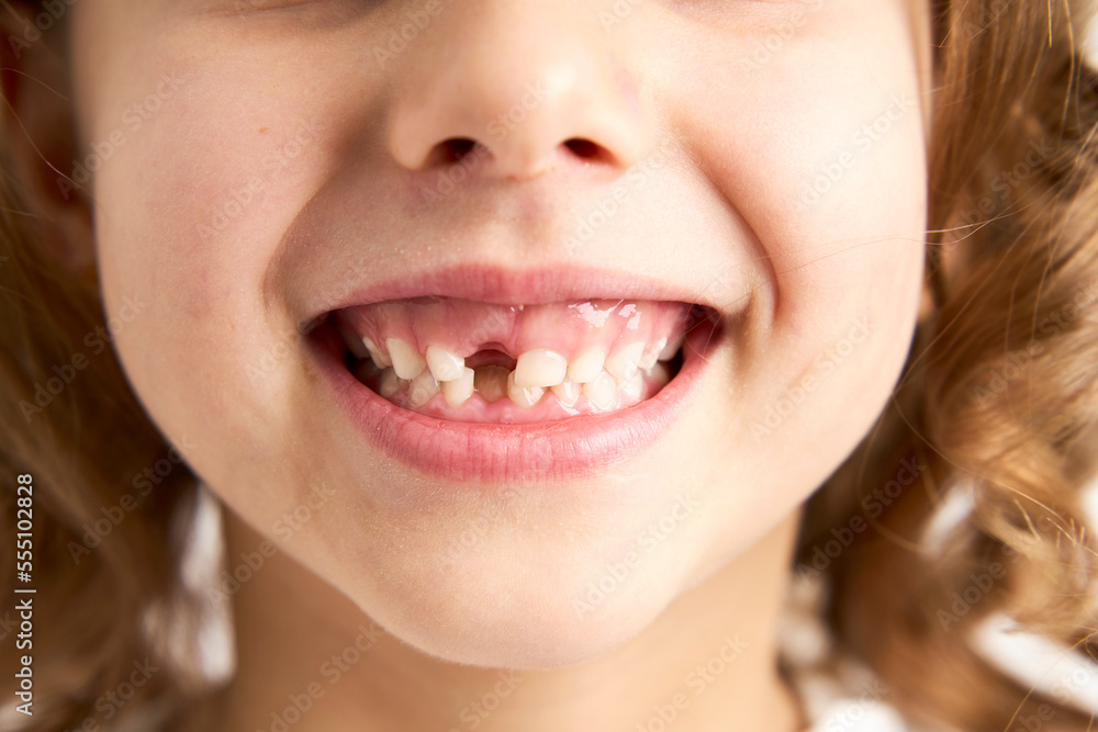 Close-up portrait of a child girl without one tooth Close-up portrait of a child girl without one tooth