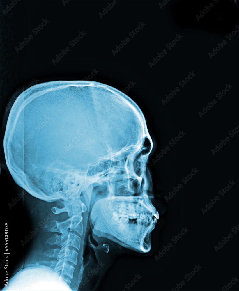 x ray image of human skull x ray image of human skull