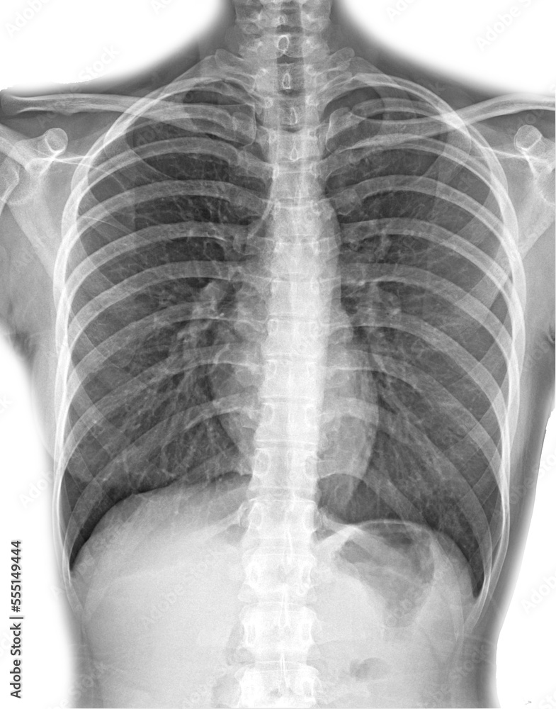 Pneumonia ( film chest xray show alveolar infiltrate at right middle