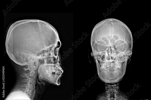 X-ray Lateral view skull and cervical spine . AP skull and cervical spine