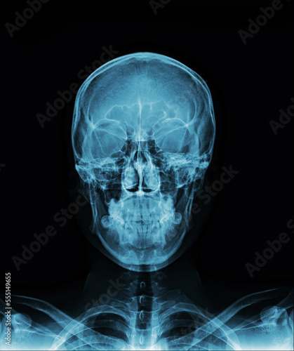 X-ray Lateral view skull and cervical spine . AP skull and cervical spine