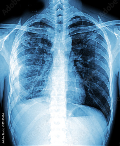 Fotografija Bronchiectasis