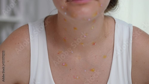 Close-up monkeypox rash on neck of young Caucasian woman sitting indoors. Sad ill lady with symptoms of transmissible contagious viral infection