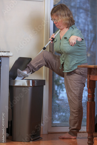 Woman with TAR Syndrome throwing something away in rubbish bin