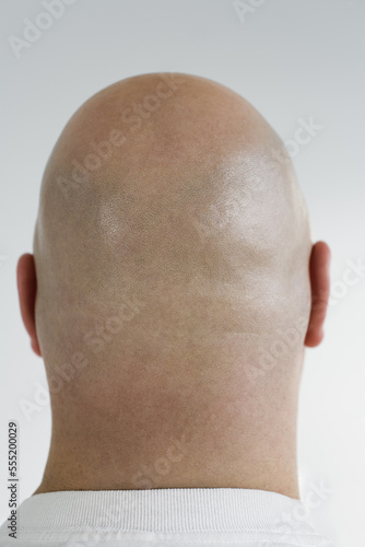 Rear view of a bald headed man.