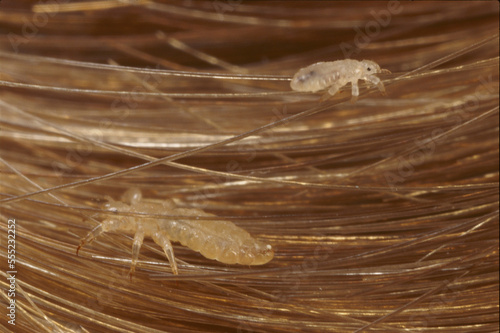 Head lice (Pediculus capitis) crawling through hair.; United States.