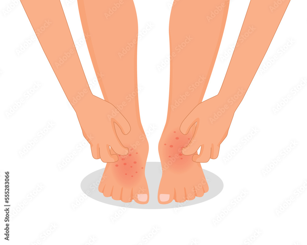 Man hand scratching his itchy feet with rash dry skin because of