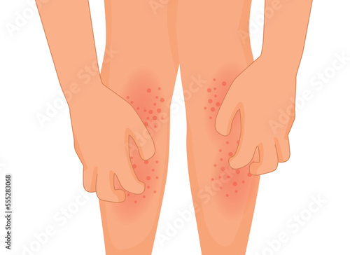 hands scratching itchy leg with rash dry skin because of allergic reaction