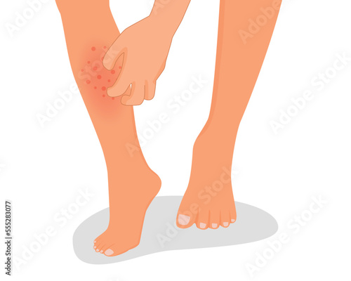 Man hand scratching his itchy leg with rash dry skin because of allergic reaction