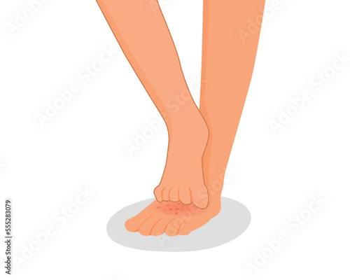 human leg scratching itchy foot with rash dry skin because of allergic reaction