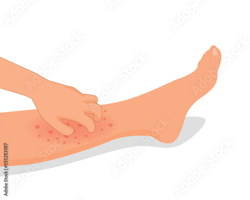 Woman hand scratching her itchy leg with rash dry skin because of allergic reaction