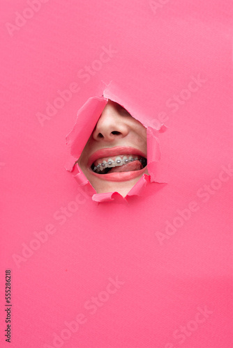 girl's face with braces on her teeth Broken pink background Open her mouth 