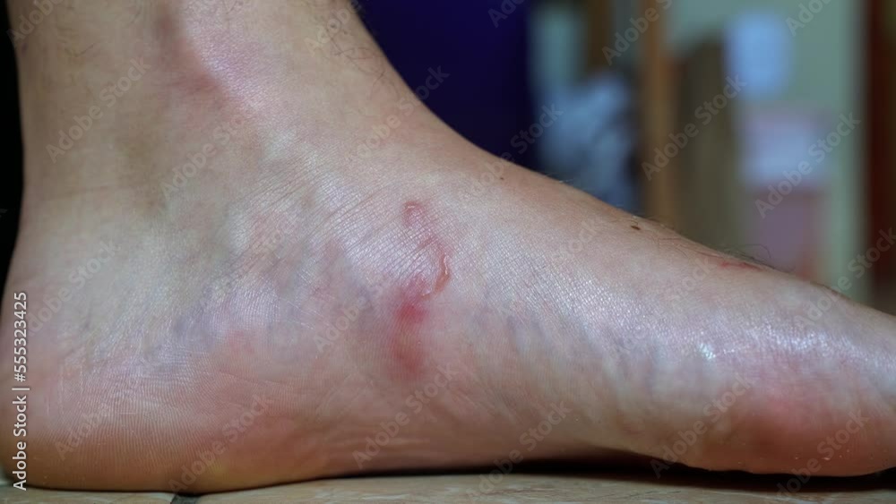 Hookworm infected foot closeup of a barefooted young male showing the