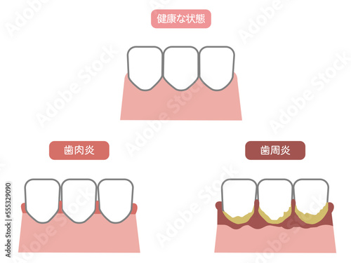 健康な歯、歯周病、歯肉炎のイラスト2