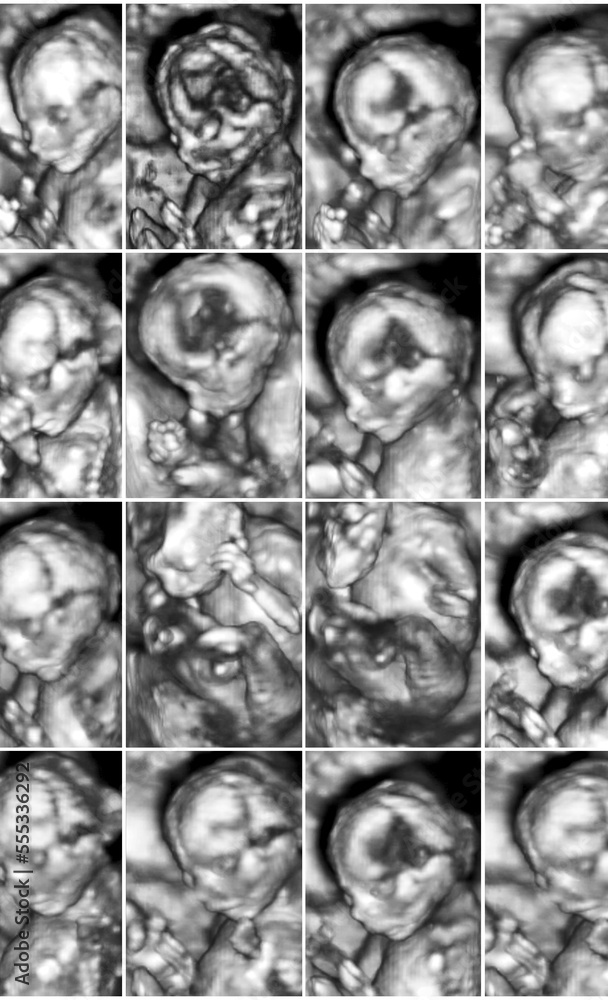 Collage of 16 medical images of 3D ultrasound anomaly scan on a female